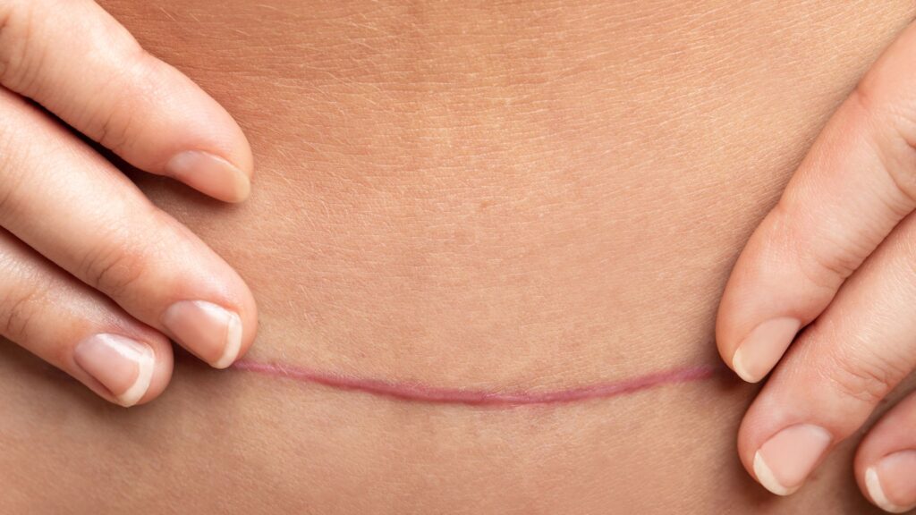 A stomach scar
